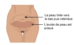 abdominoplastie haute tension tunisie